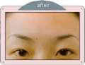 [After Botox]