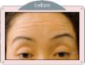 [Before Botox treatment]