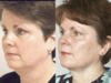 [Liposuction]